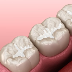 Close-up of molar teeth with white dental sealants applied to the grooves on the chewing surfaces.