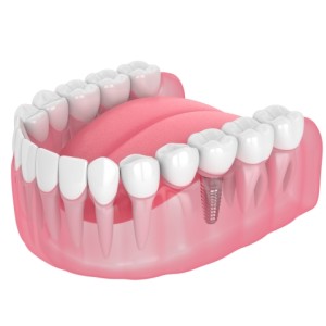 3D illustration of lower jaw showing dental implant with crown among natural teeth.