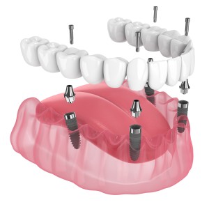 3D illustration of dental implants supporting a fixed upper denture with screws and abutments visible in the pink gums.