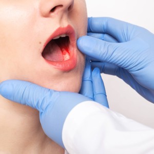 Close-up of a dentist in blue gloves examining a patient's open mouth and gums.