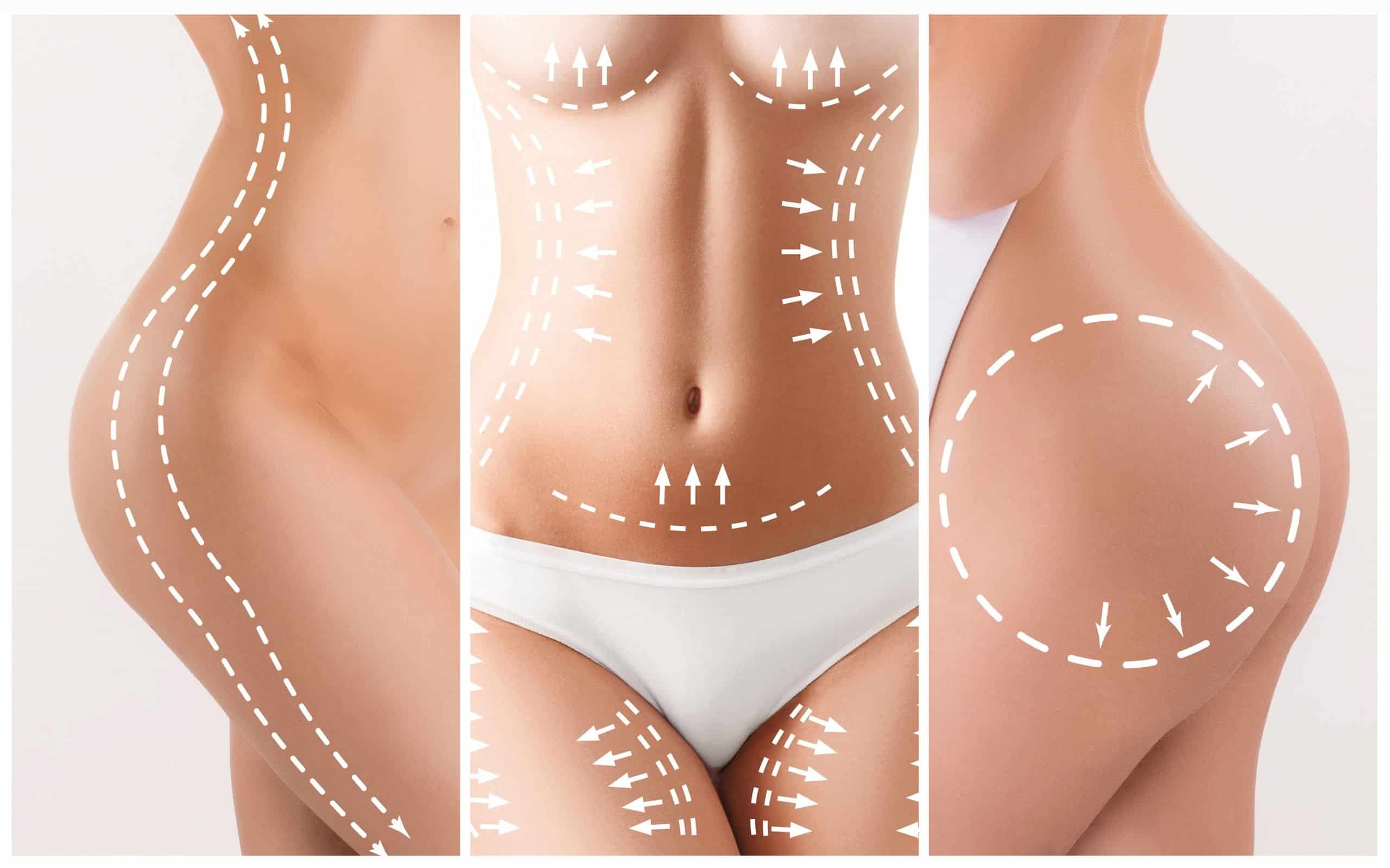 Mommy Makeover Surgery: Procedure, Aftercare, and Recovery