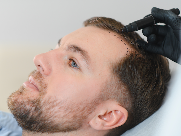 Hair Transplant | MEDICTE