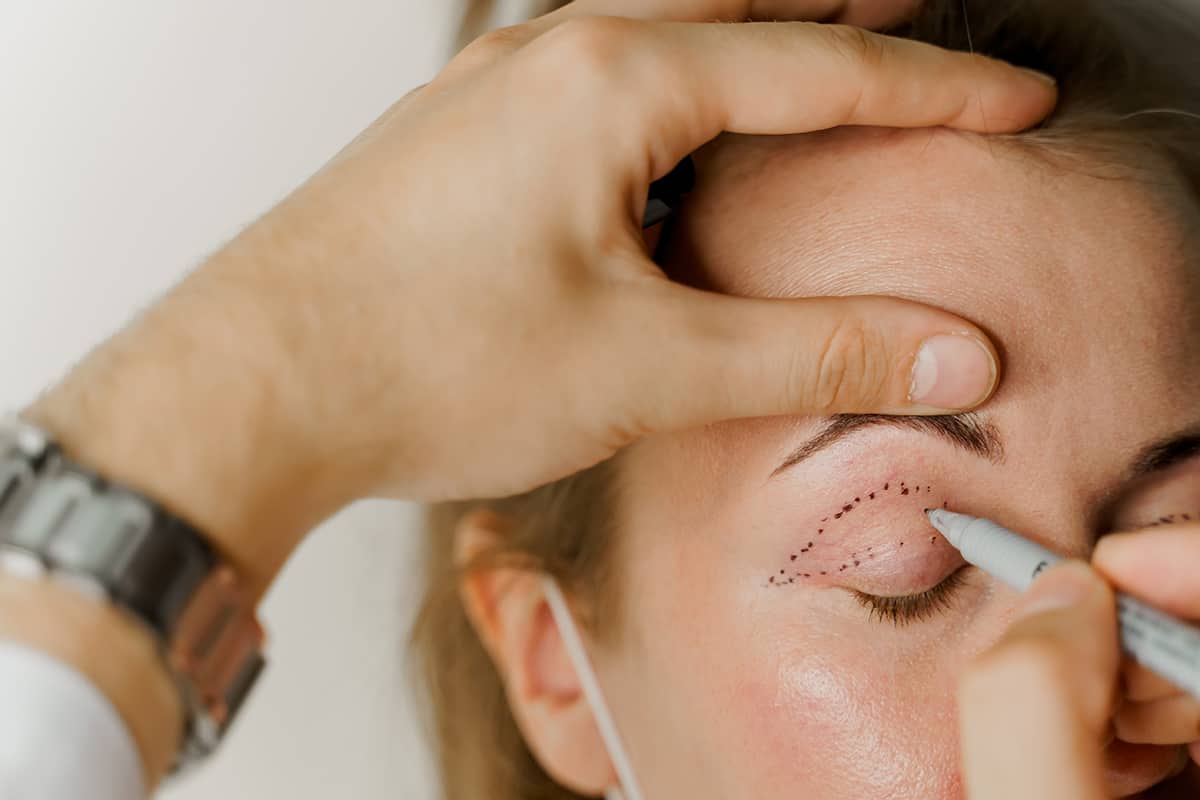 4 Signs You're a Good Candidate for Eyelid Surgery