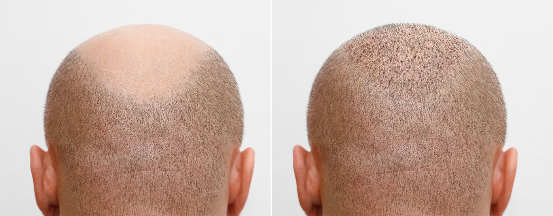 The Science Behind Hair Transplantation | Hair Transplant Blog at Eugenix