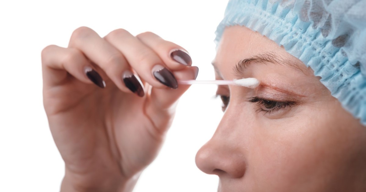 Recovery time after blepharoplasty