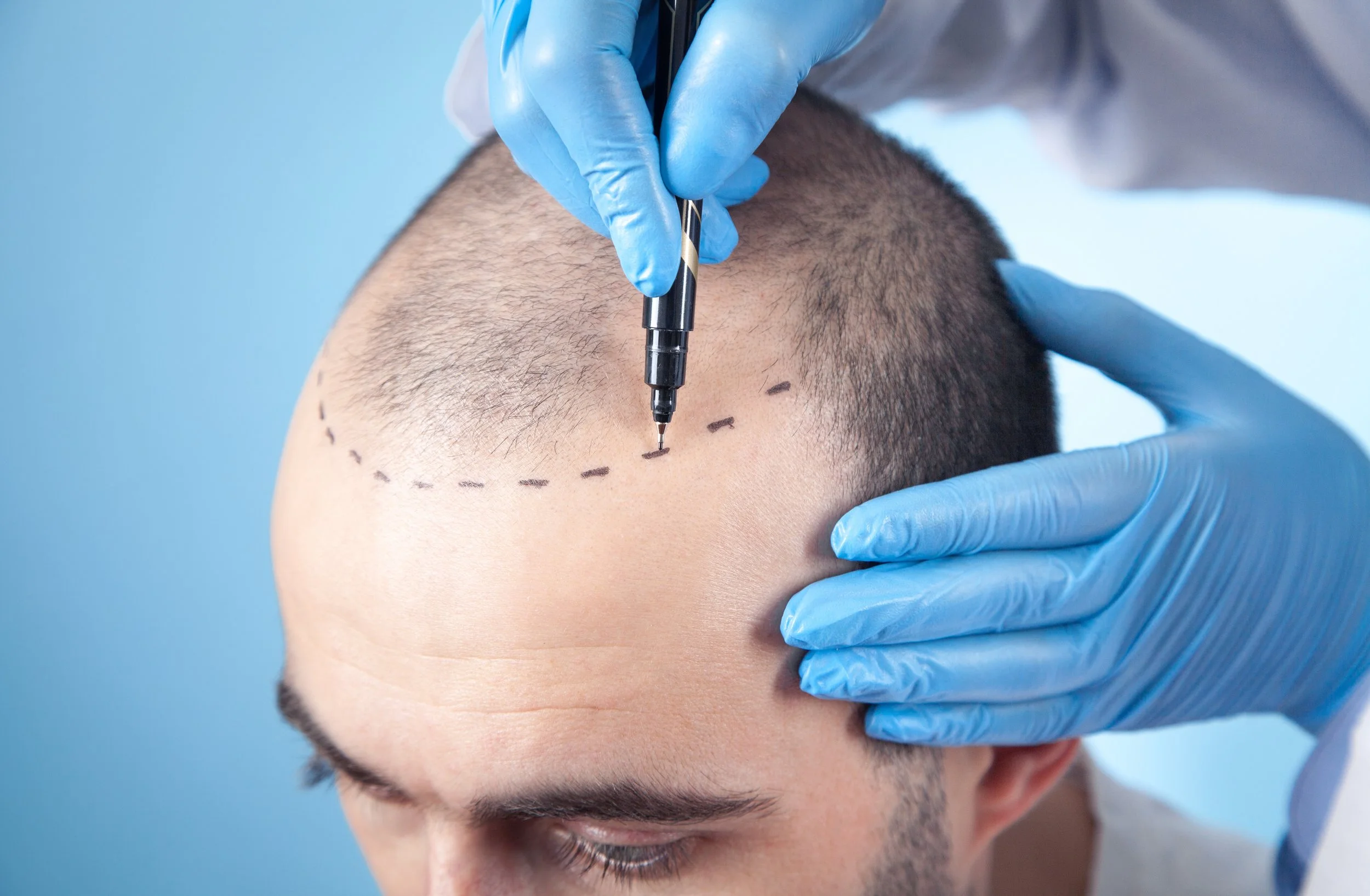 How Hair Transplantation Works: What You Need to Know