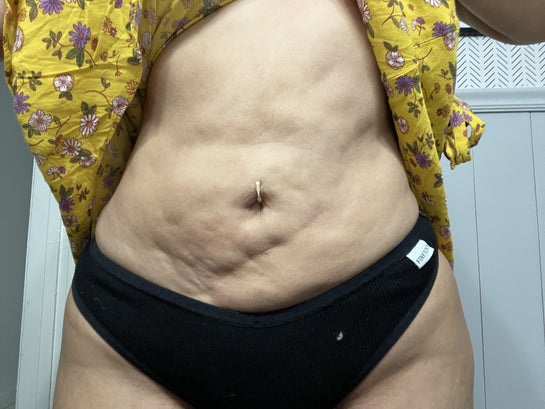 Botched Lipo - is there a fix that doesn't involve another surgery? (Photo)