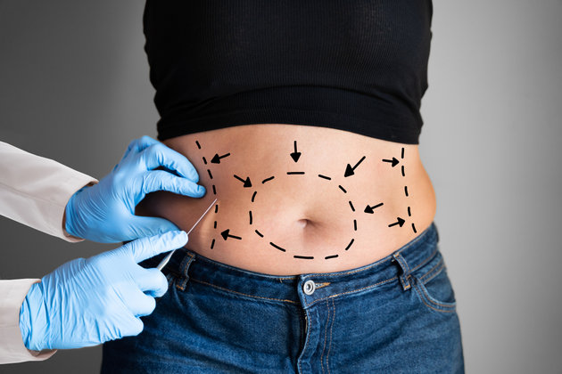 What is Liposuction, and Who Can Undergo It? | Anadolu Sağlık Merkezi