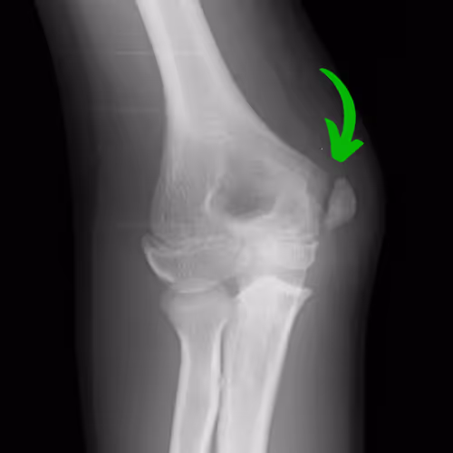 X-ray image of a pediatric patient with little league elbow.