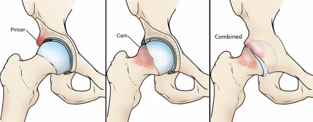 Types of hip impingement
