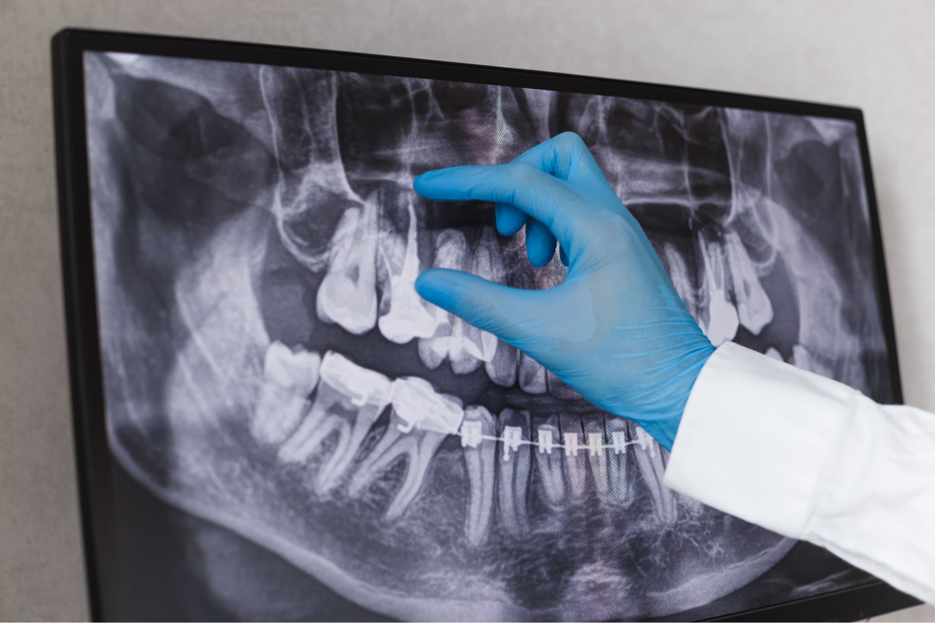Hand wearing a blue glove pointing at a dental X-ray showing teeth and jawbone with braces.