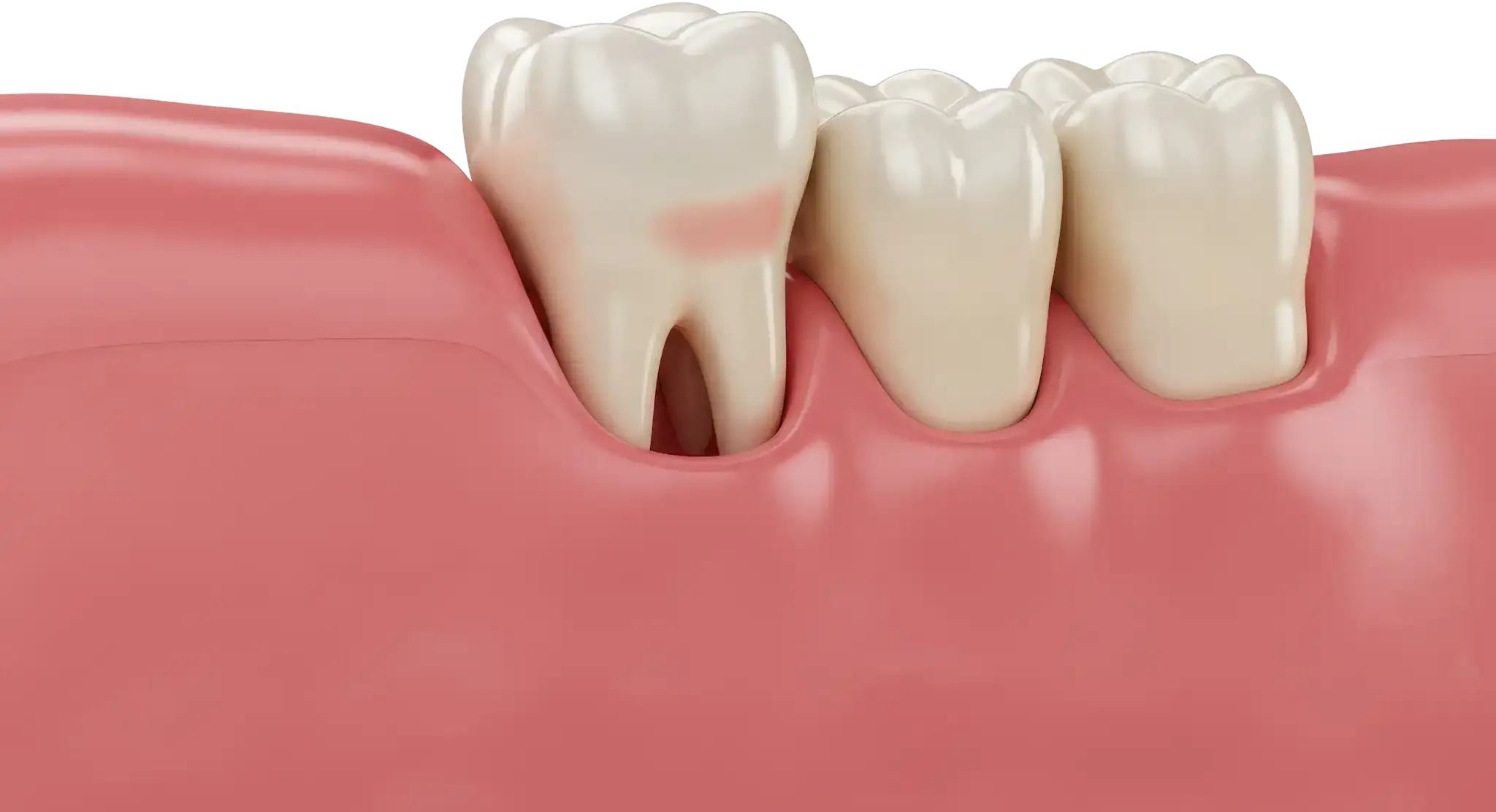 Three molar teeth partially embedded in pink gums, with one tooth showing exposed roots due to receding gum.