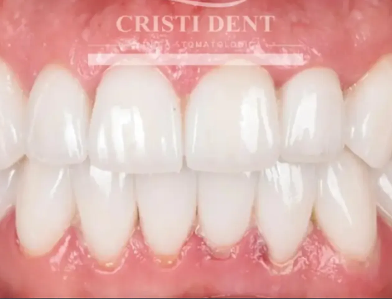 Close-up of healthy, clean upper and lower front teeth with pink gums.