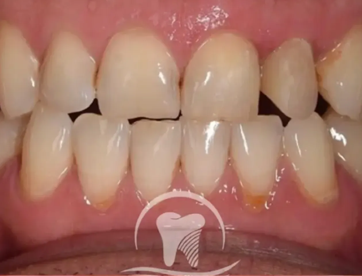 Close-up of teeth showing chipped front upper teeth and signs of plaque buildup near the gums.
