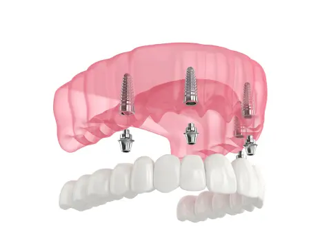 Dental implant model showing four implants in the upper jaw supporting a full arch prosthesis.