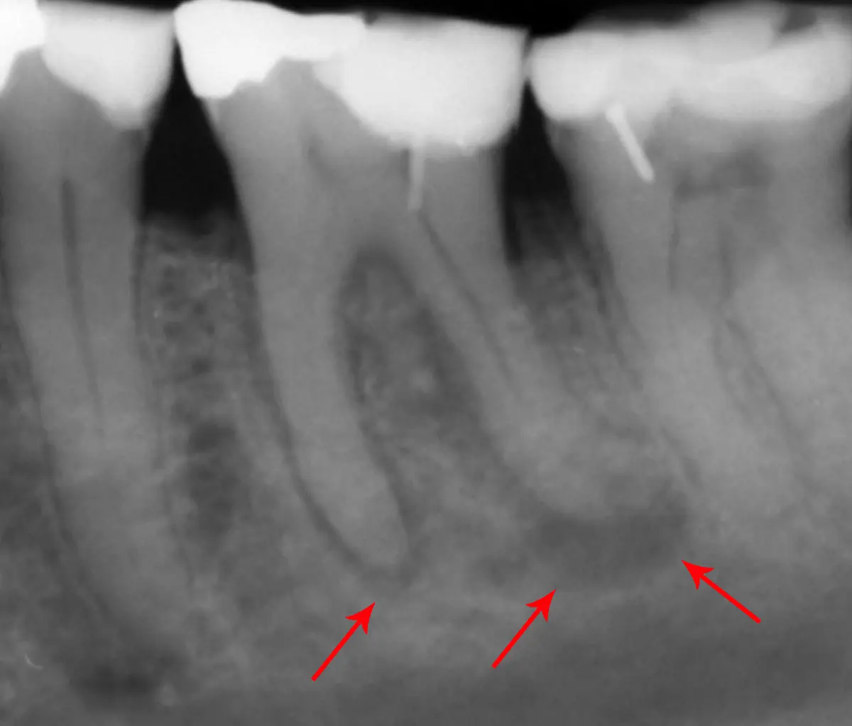 Radiografie retroalveolară: leziuni inflamatorii la vârful rădăcinilor