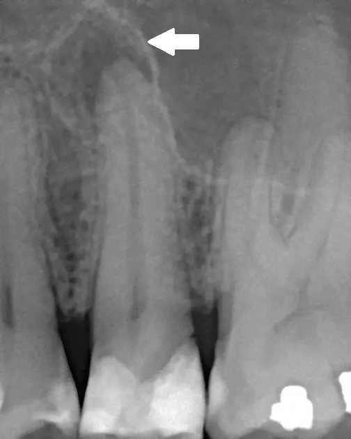 Radiografie: zonă întunecată la vârful rădăcinii premolarului
