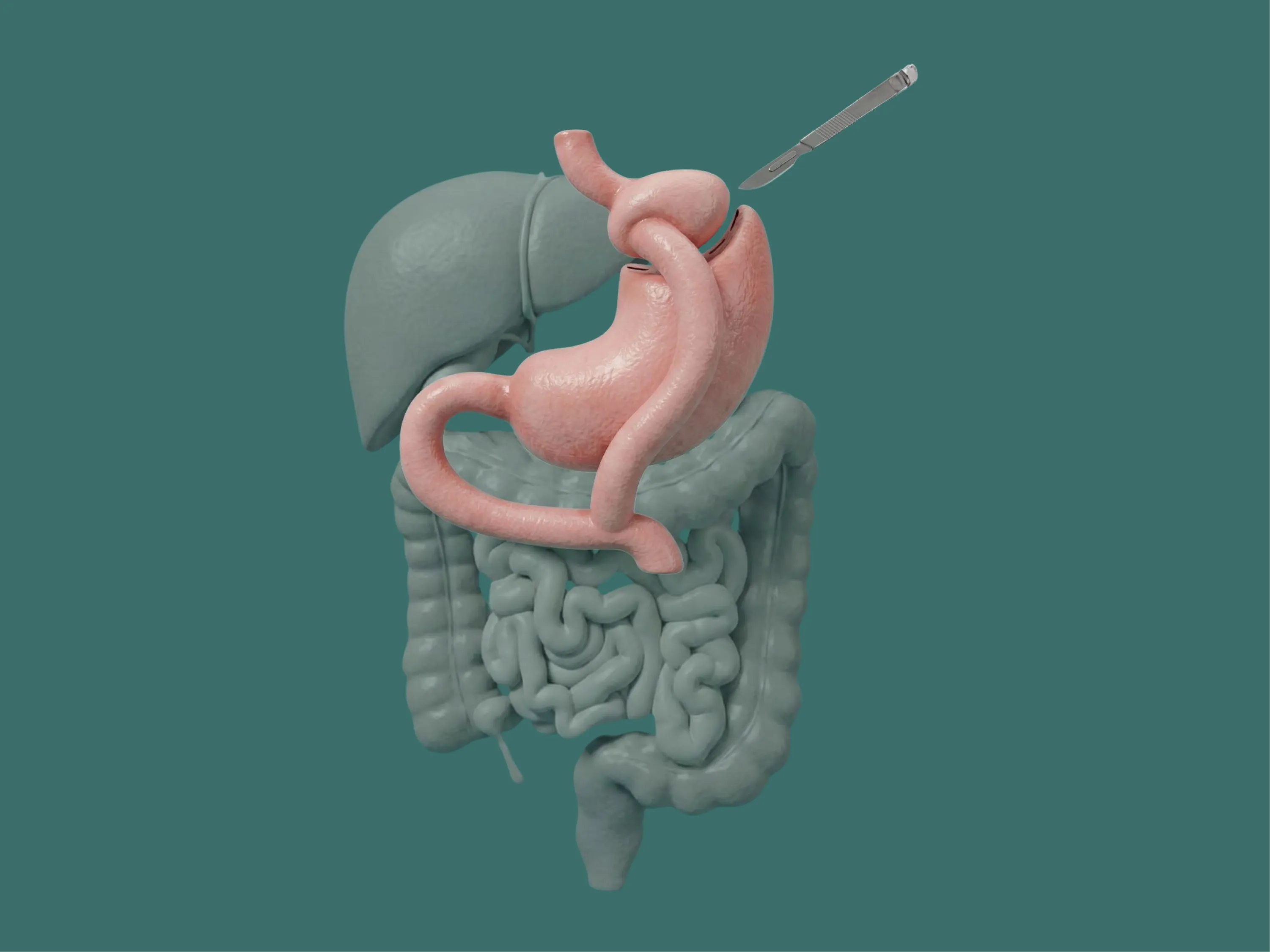 Illustration anatomique en 3D de l'estomac remodelé après un bypass gastrique, avec un scalpel chirurgical.