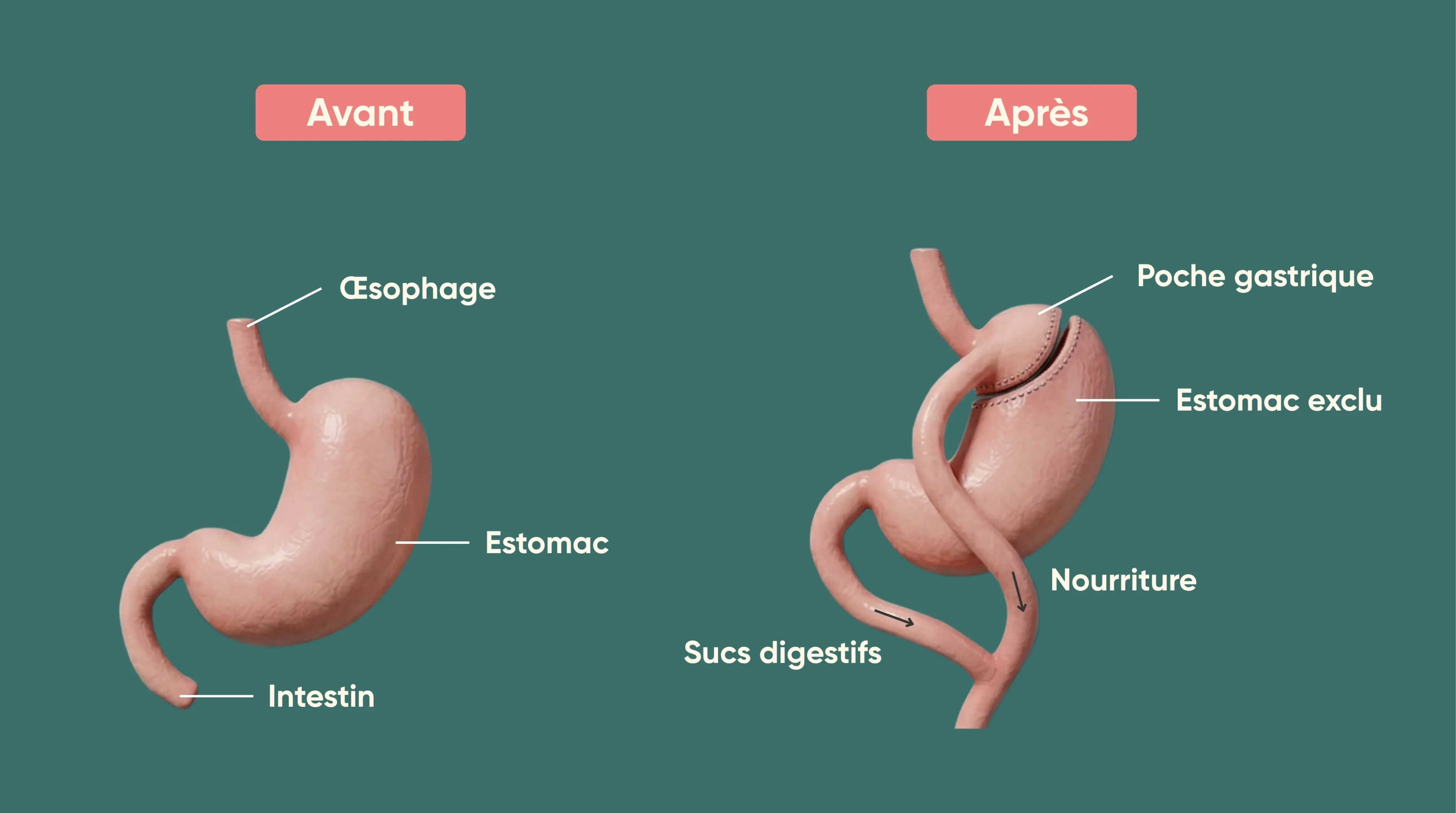 Infographie : anatomie de l'estomac avant et après un bypass gastrique.