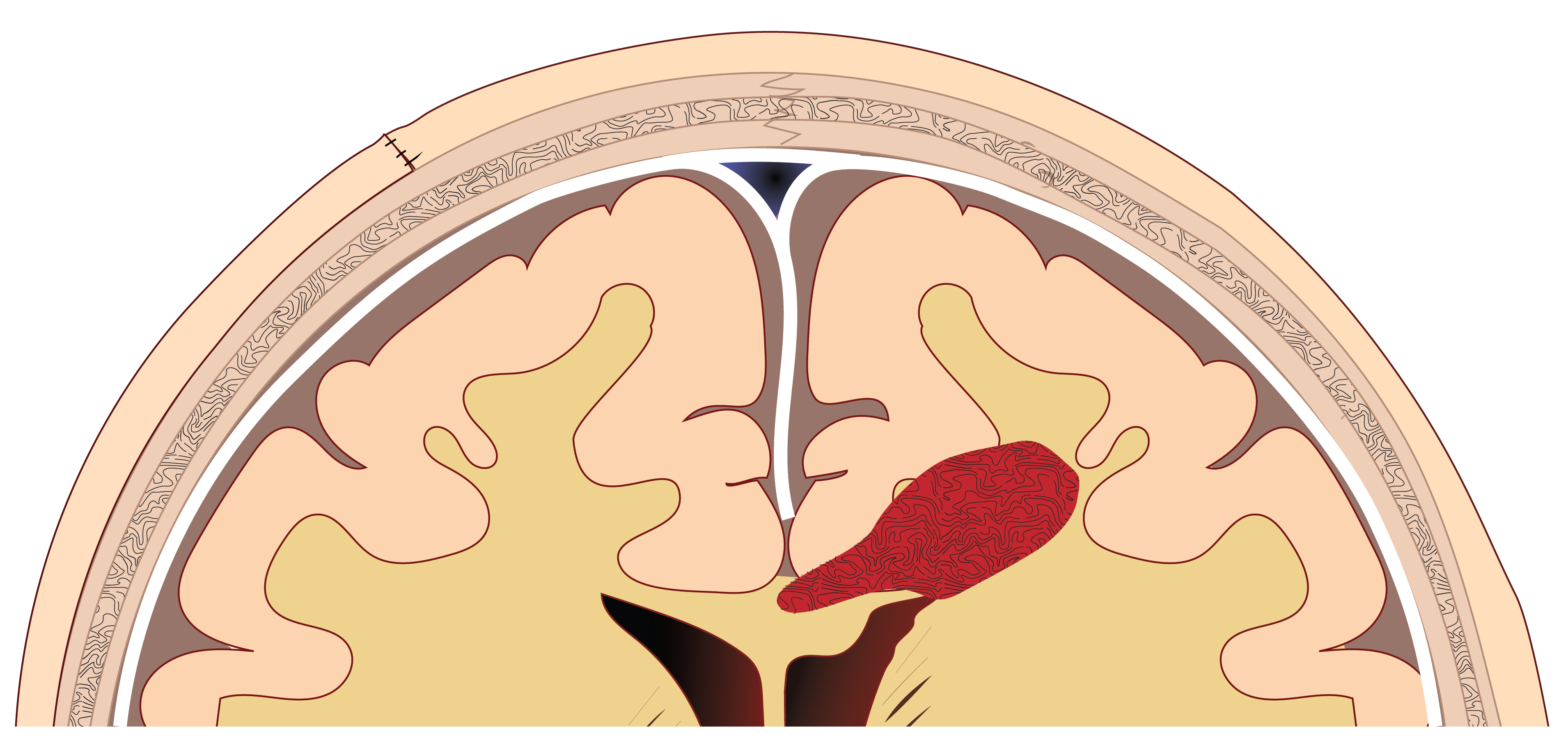 Cross-section of brain showing red area indicating an intracerebral hemorrhage in the right hemisphere.