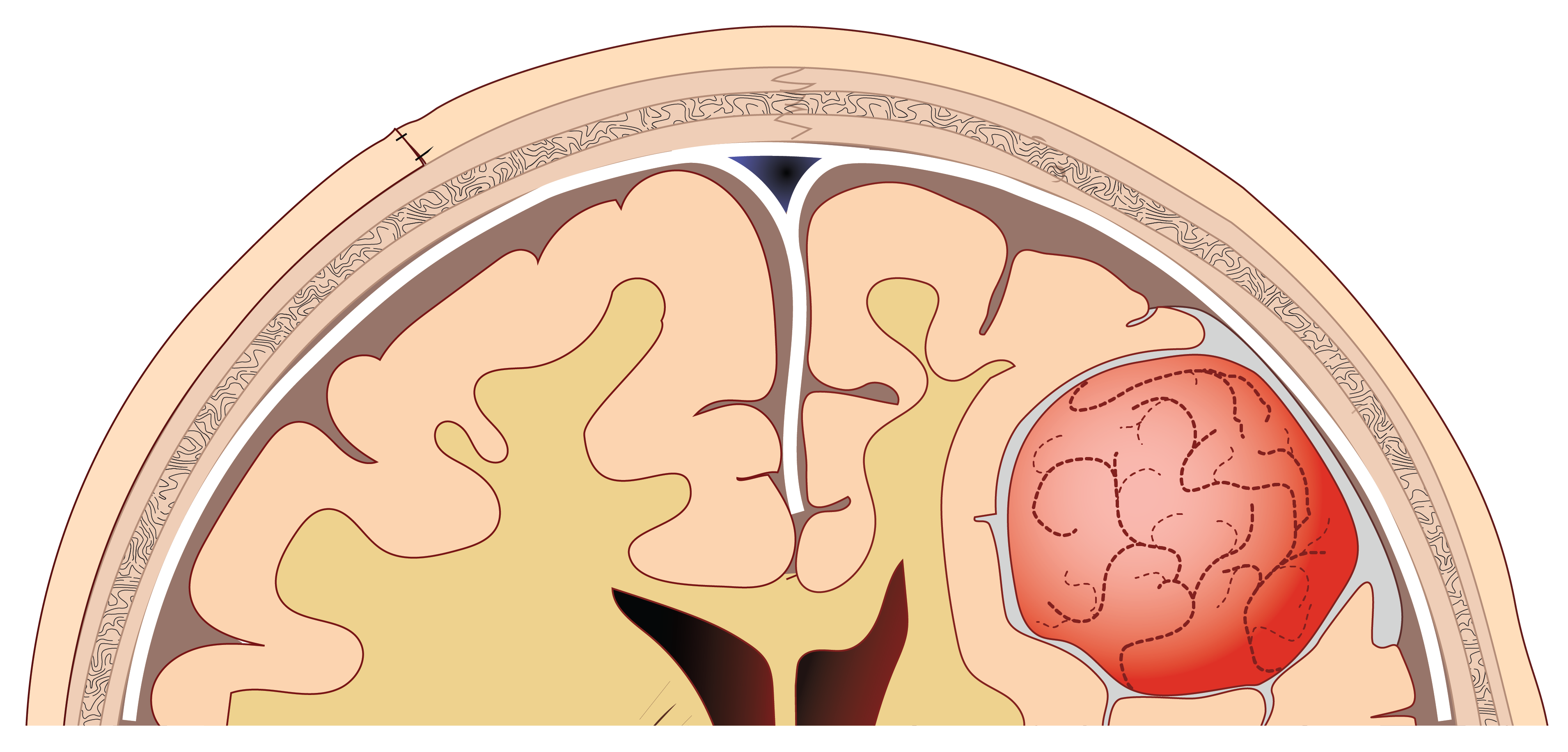 Cross-section of brain showing a red tumor on the right side beneath the skull layers.