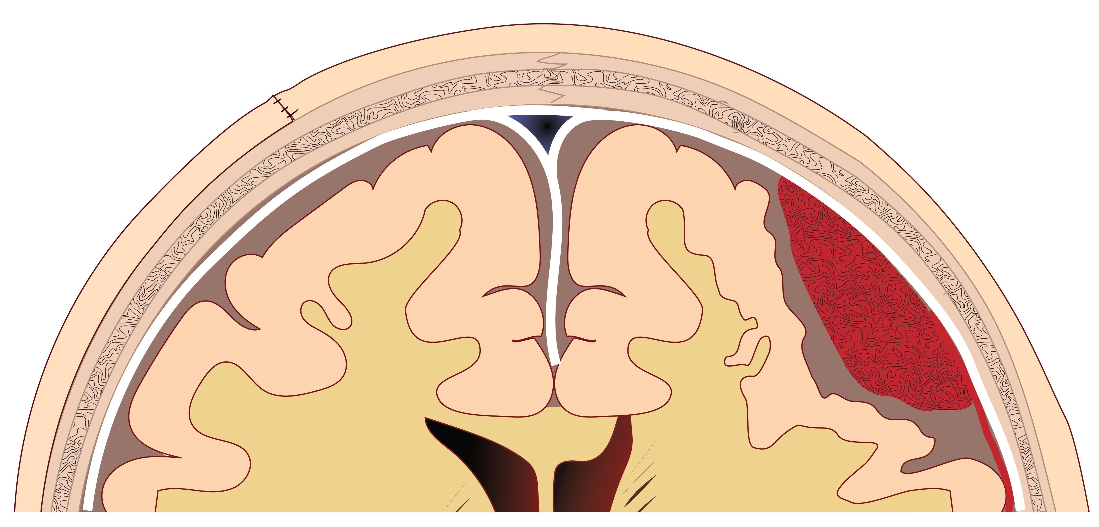 Cross-section of a human brain showing cortical layers and a red highlighted area on the right side.