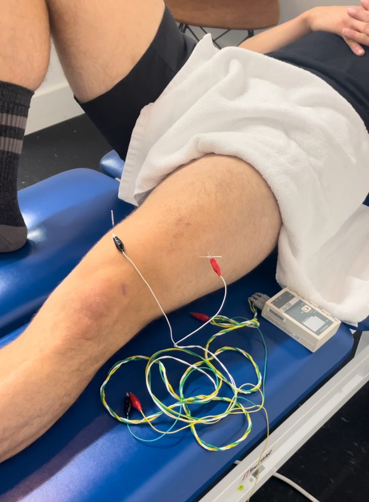 Dry needling physical therapy