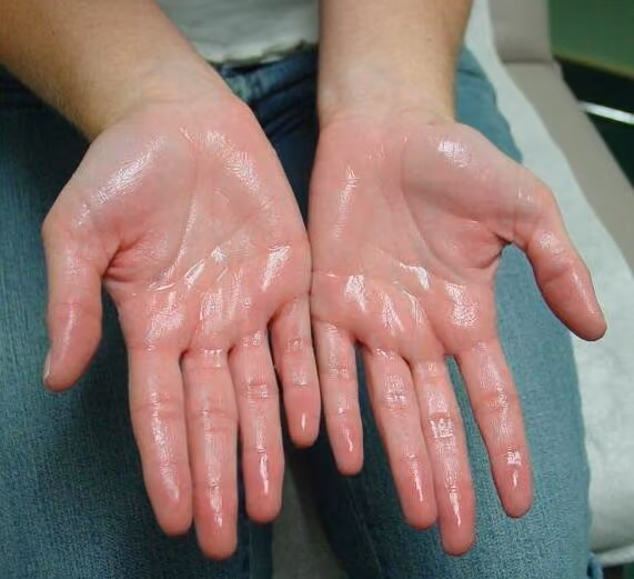 Excessive sweating (Hyperhidrosis)