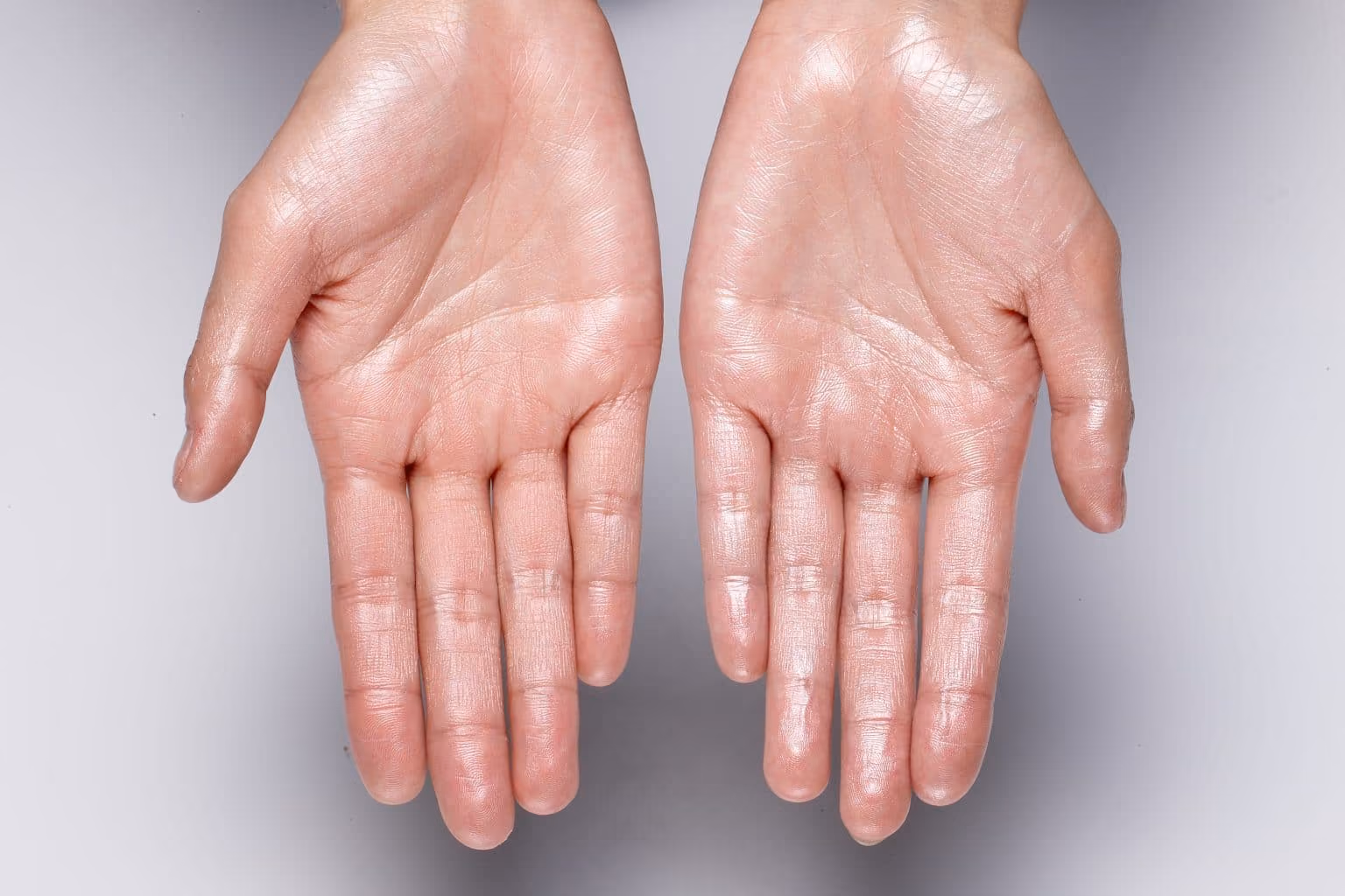 Excessive Sweating (Hyperhidrosis)