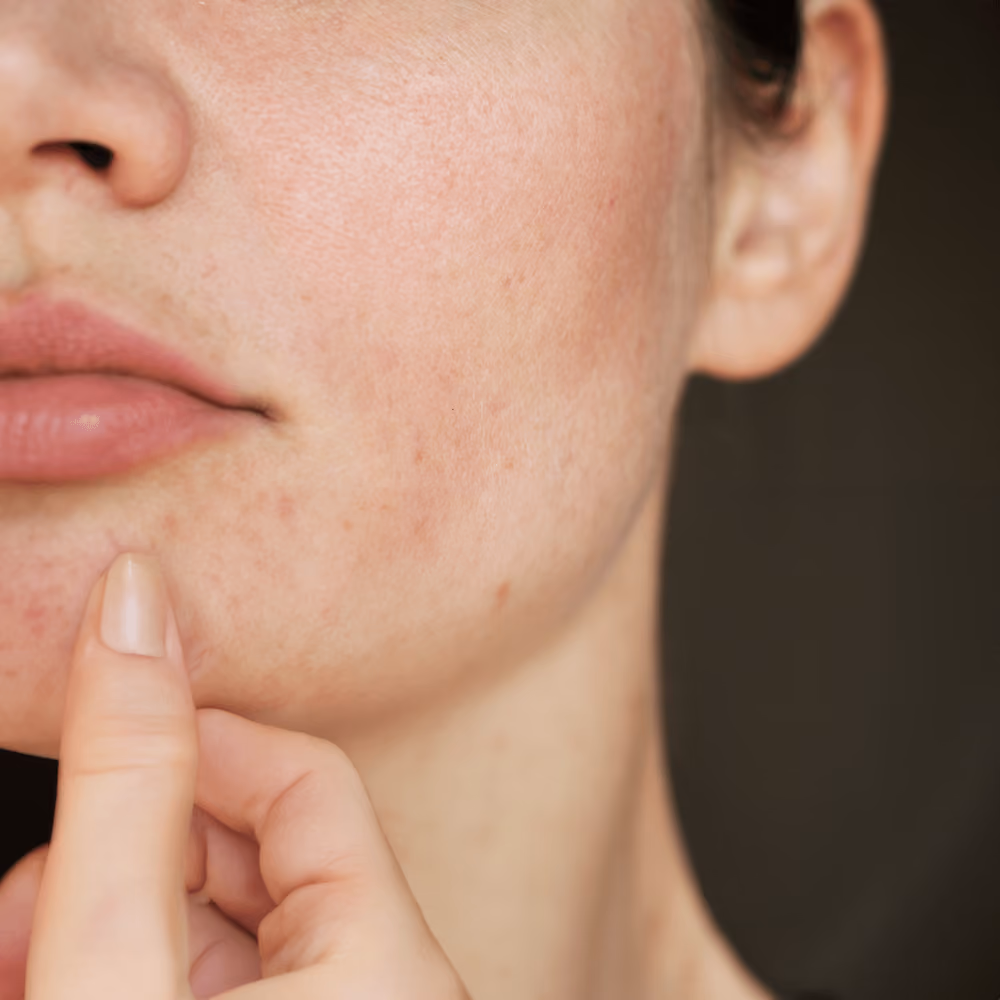 Dull Skin & Poor Skin Texture