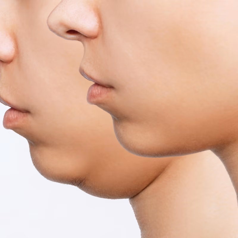 Double Chin & Under-Chin Fullness