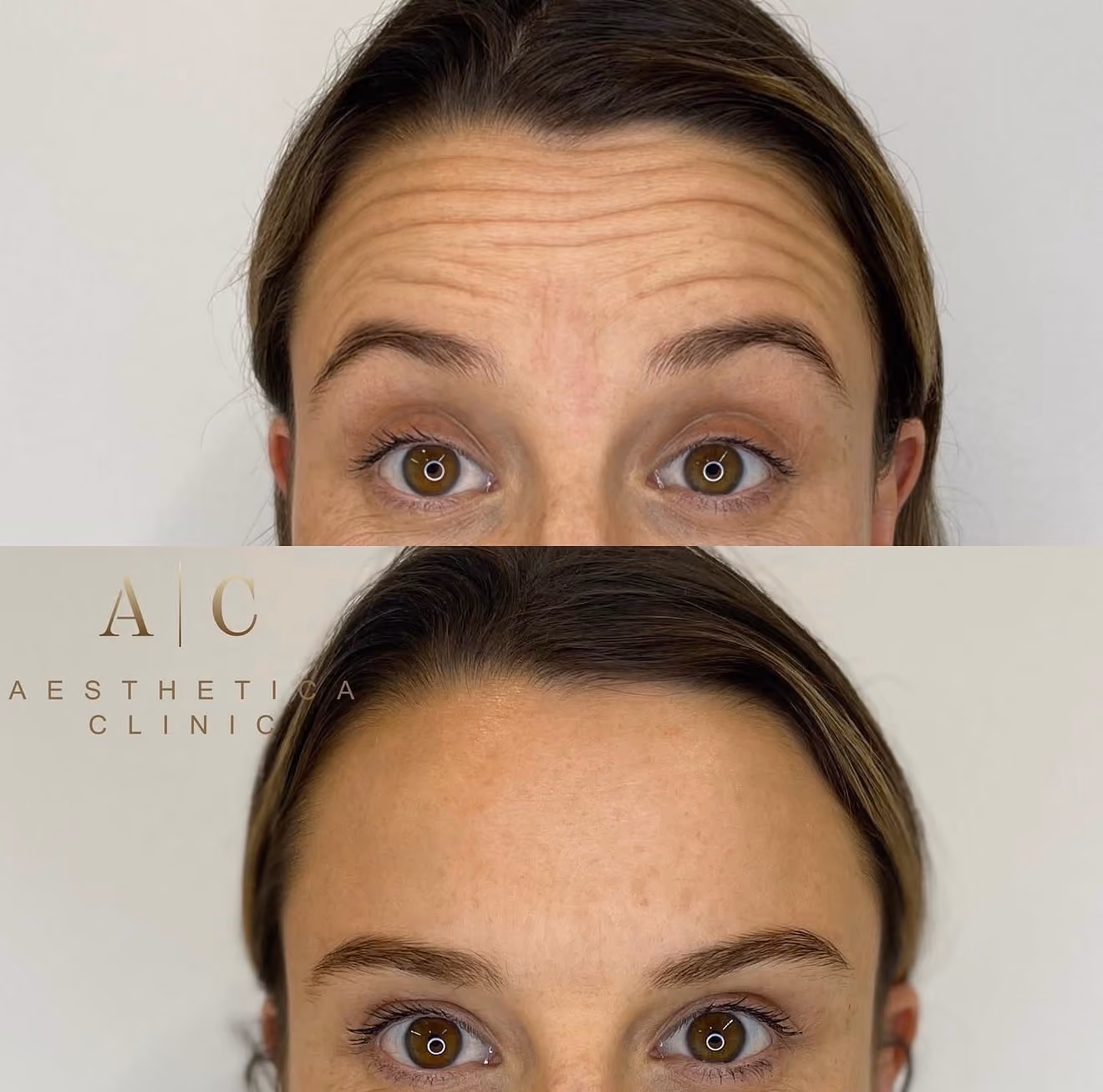 Anti-Wrinkle Injections Christchurch | Aesthetica