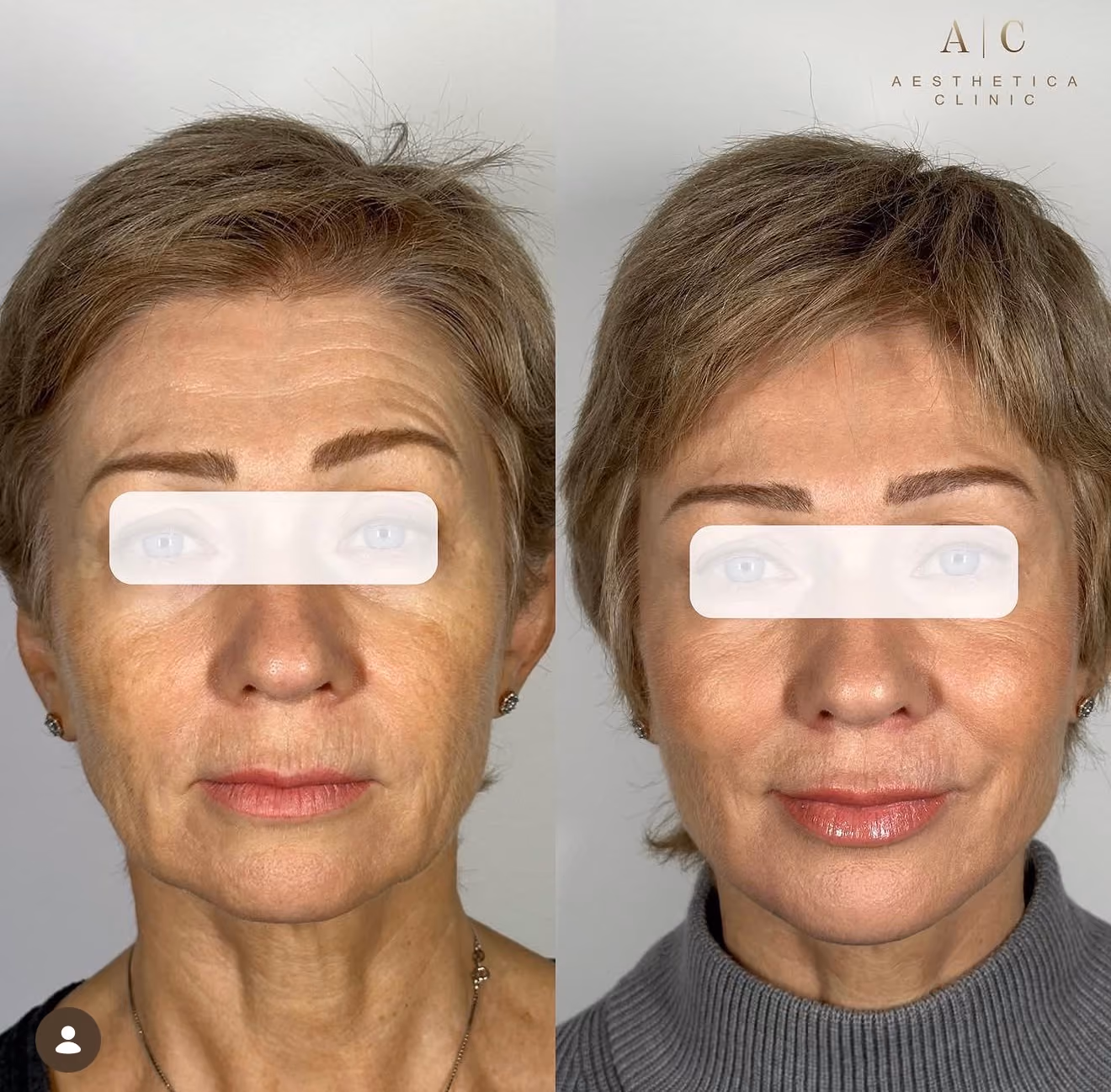 Collagen Stimulation Christchurch | Aesthetica