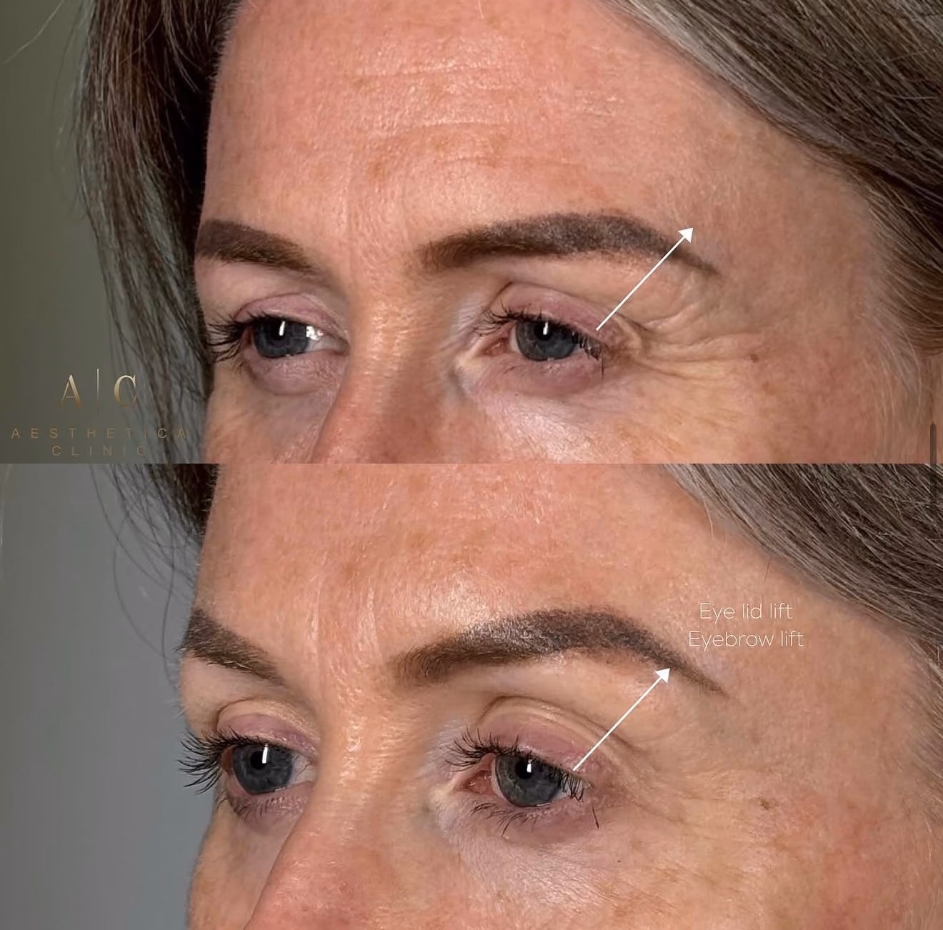 Anti-Wrinkle Treatments Christchurch | Aesthetica Clinic