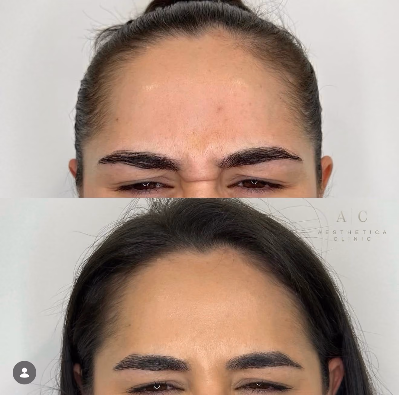 Anti-Wrinkle Treatments Christchurch | Aesthetica Clinic
