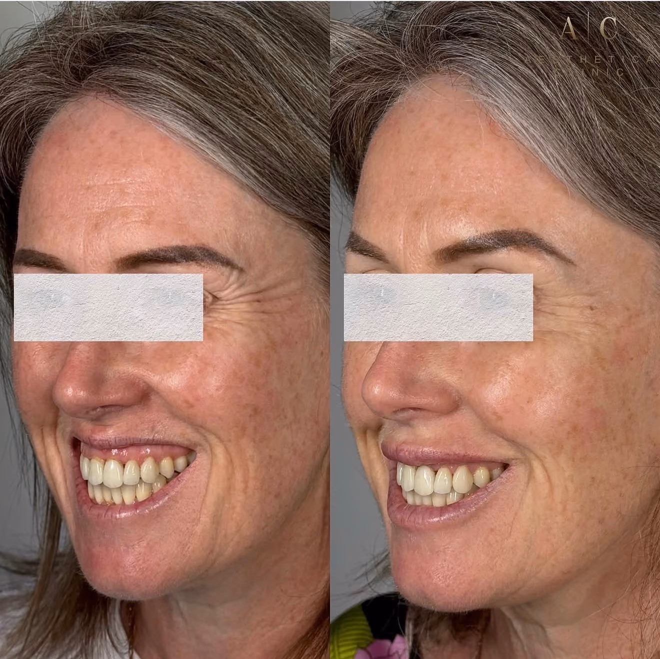 Anti-Wrinkle Injections Christchurch | Aesthetica