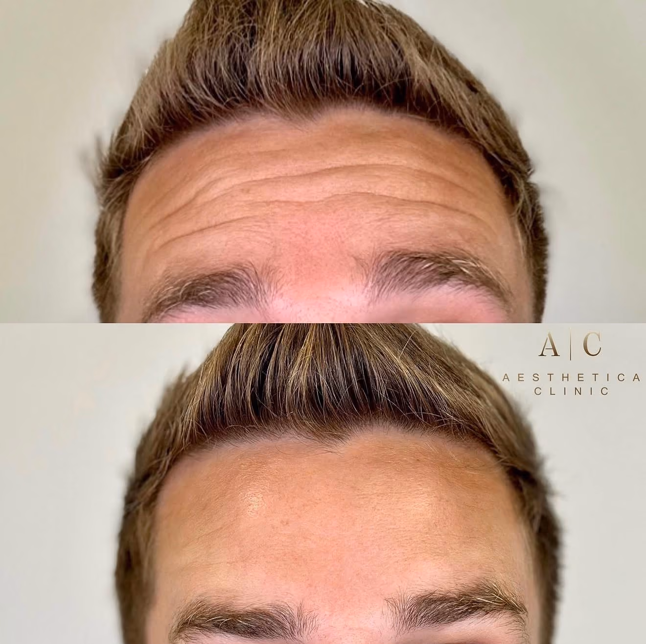 Anti-Wrinkle Treatments Christchurch | Aesthetica Clinic