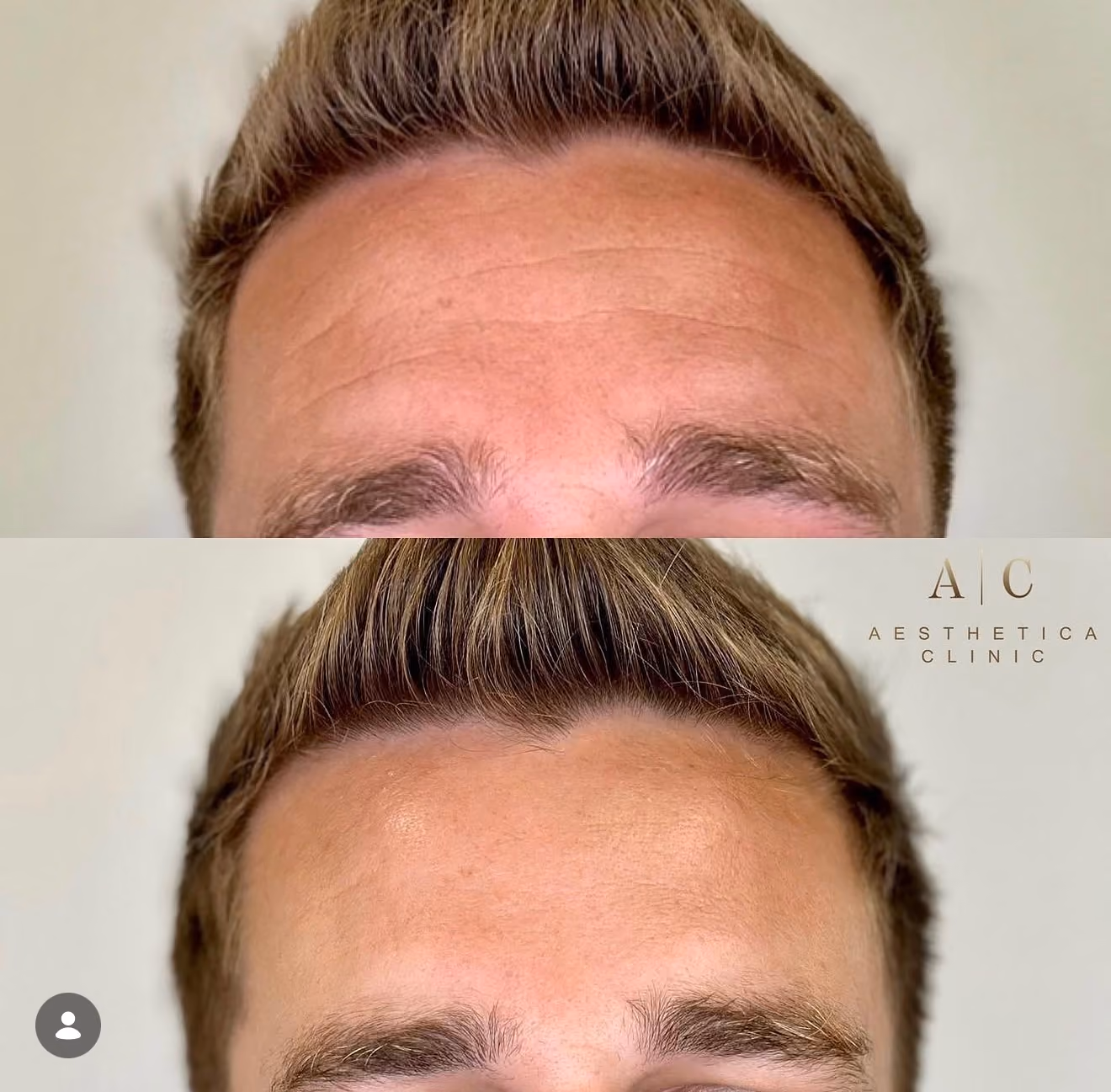 Anti-Wrinkle Treatments Christchurch | Aesthetica Clinic