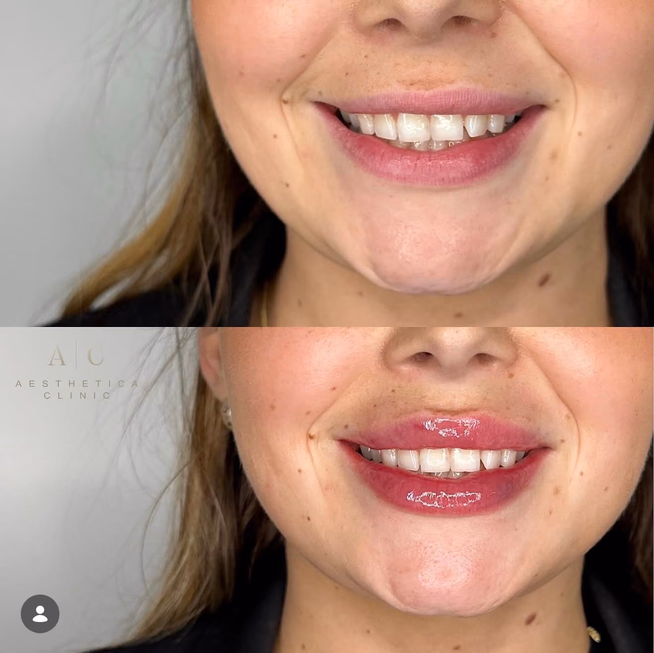 Dermal Fillers Christchurch | Aesthetica