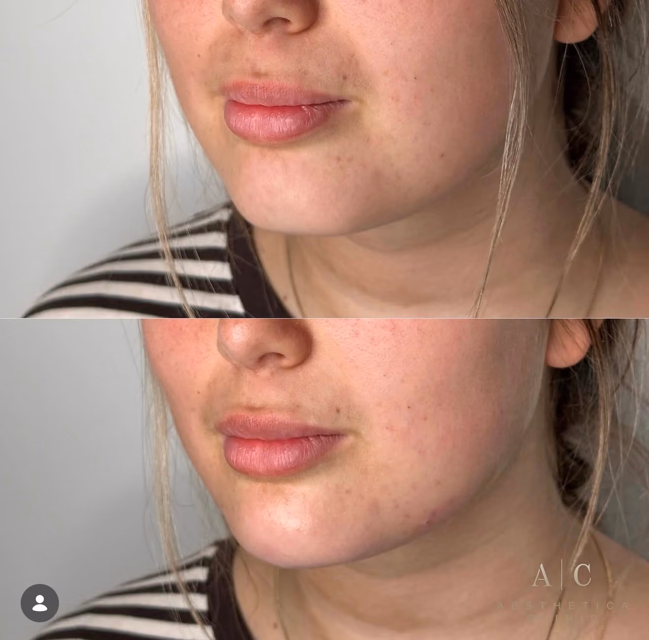 Dermal Fillers Christchurch | Aesthetica