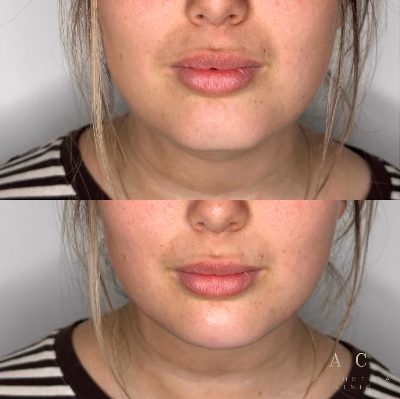 Dermal Fillers Christchurch | Aesthetica