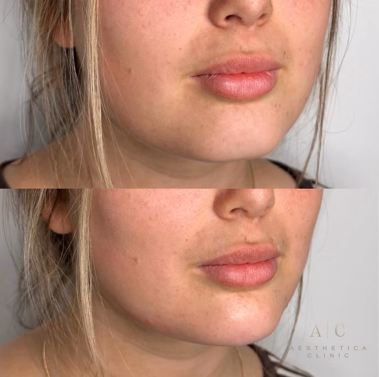 Dermal Fillers Christchurch | Aesthetica