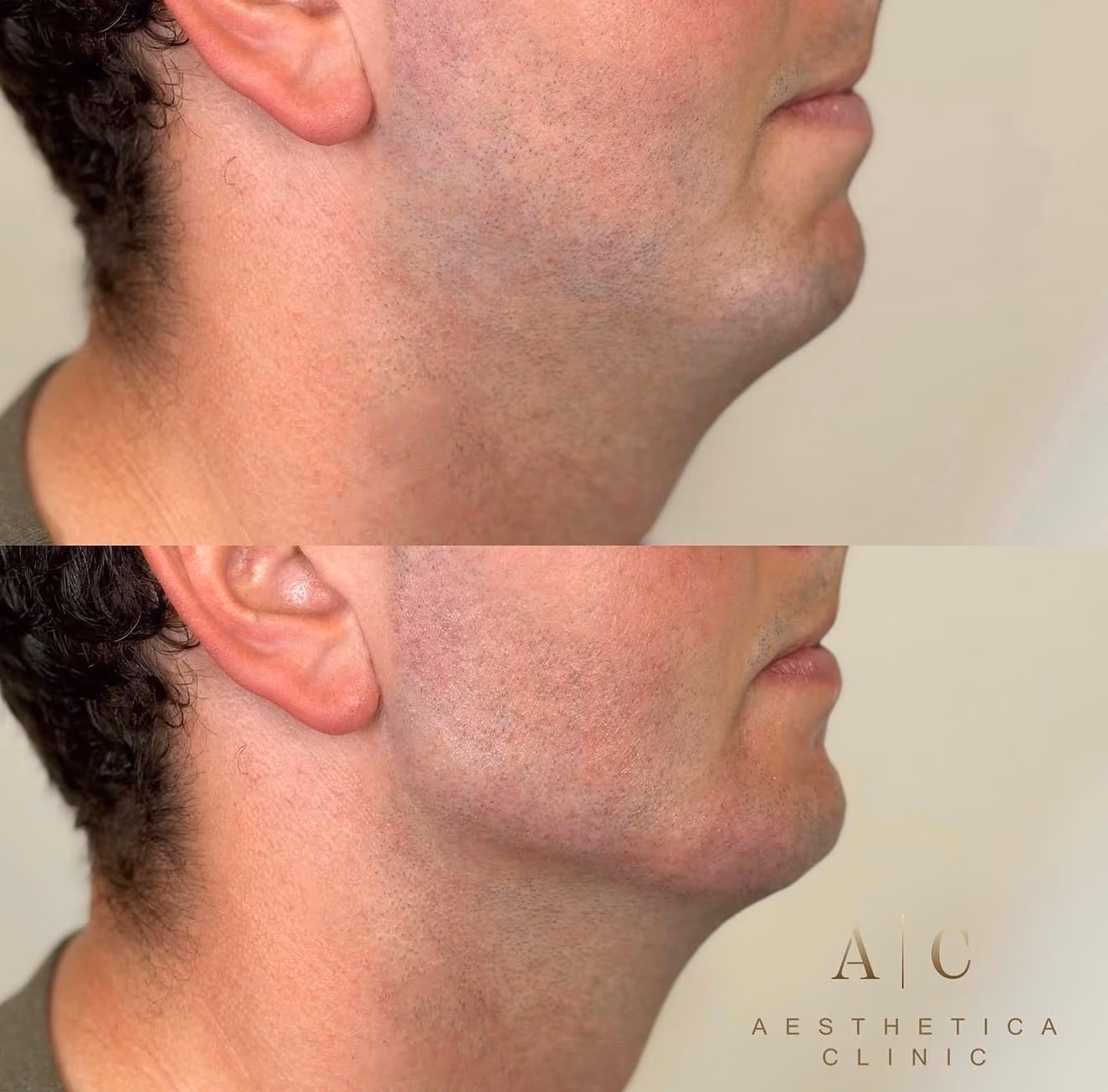 Dermal Fillers Christchurch | Aesthetica