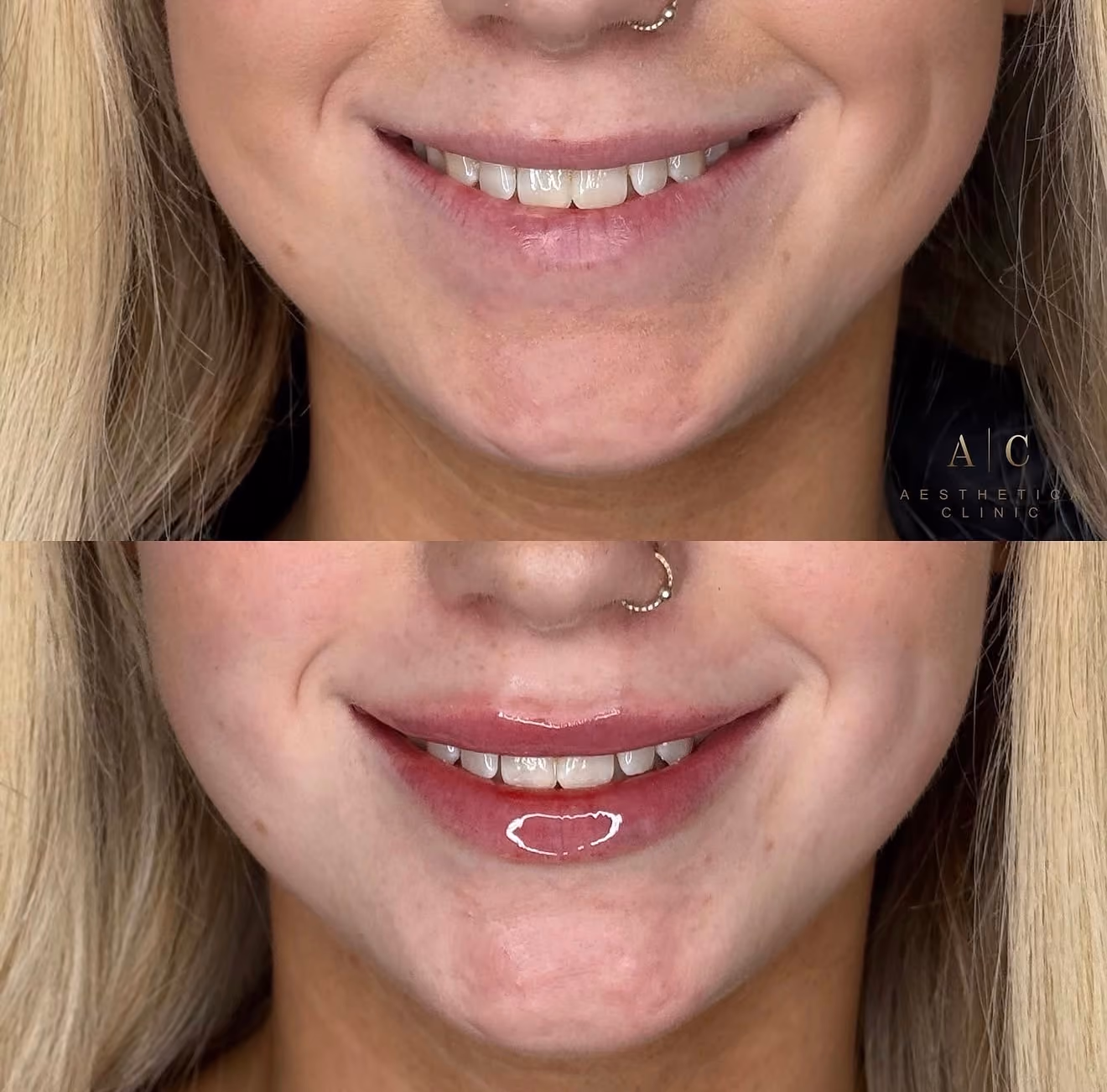 Dermal Fillers Christchurch | Aesthetica