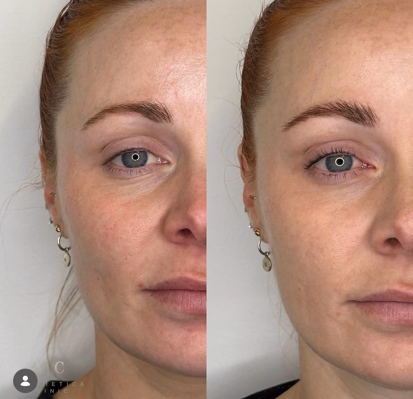 Collagen Stimulation Christchurch | Aesthetica