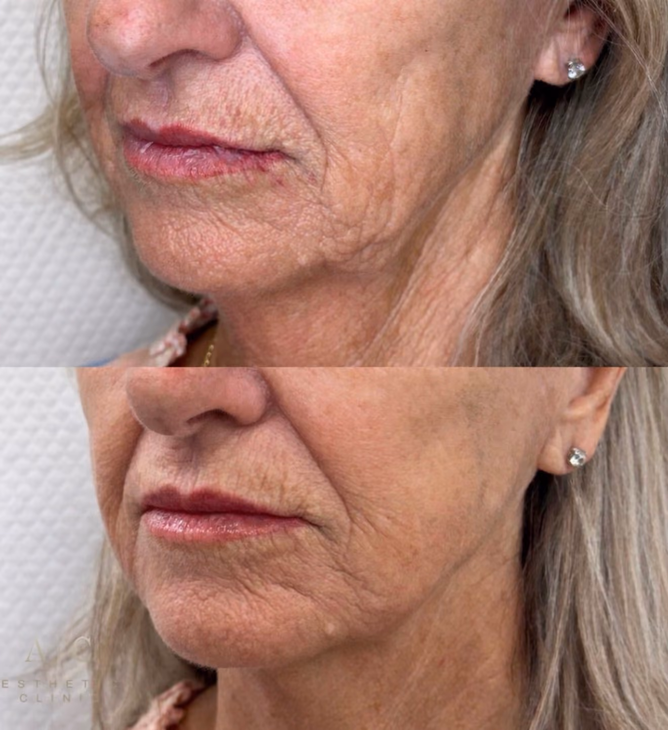 Collagen Stimulation Christchurch | Aesthetica