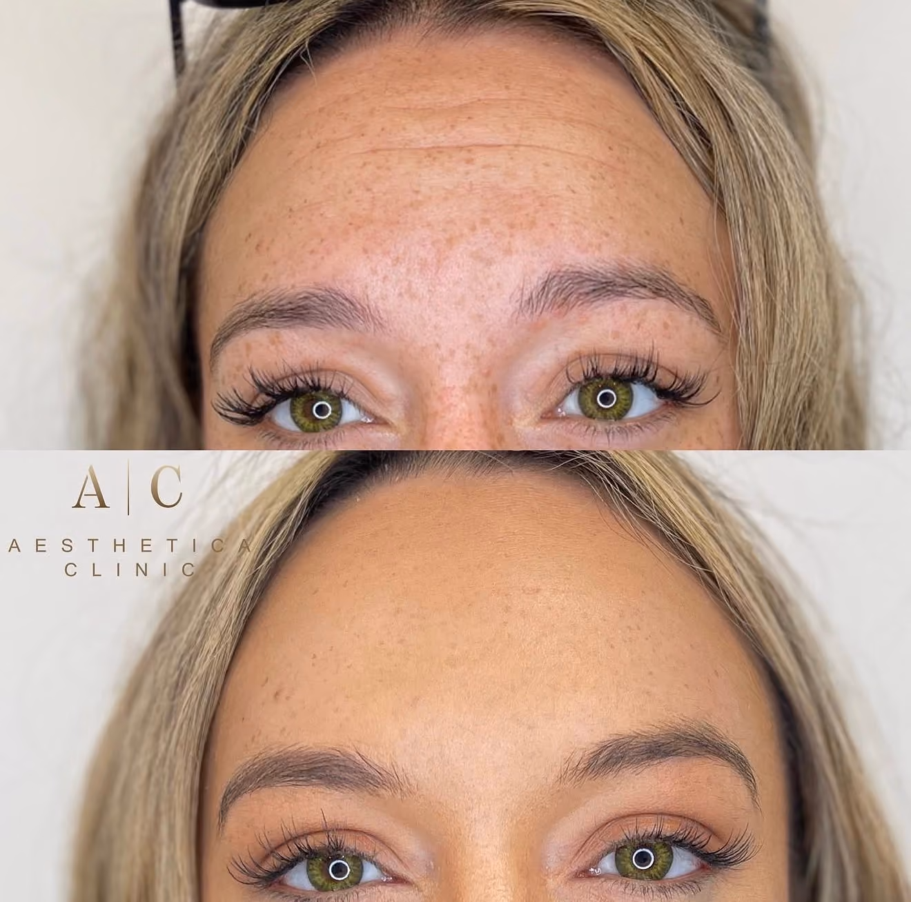 Anti-Wrinkle Treatments Christchurch | Aesthetica Clinic