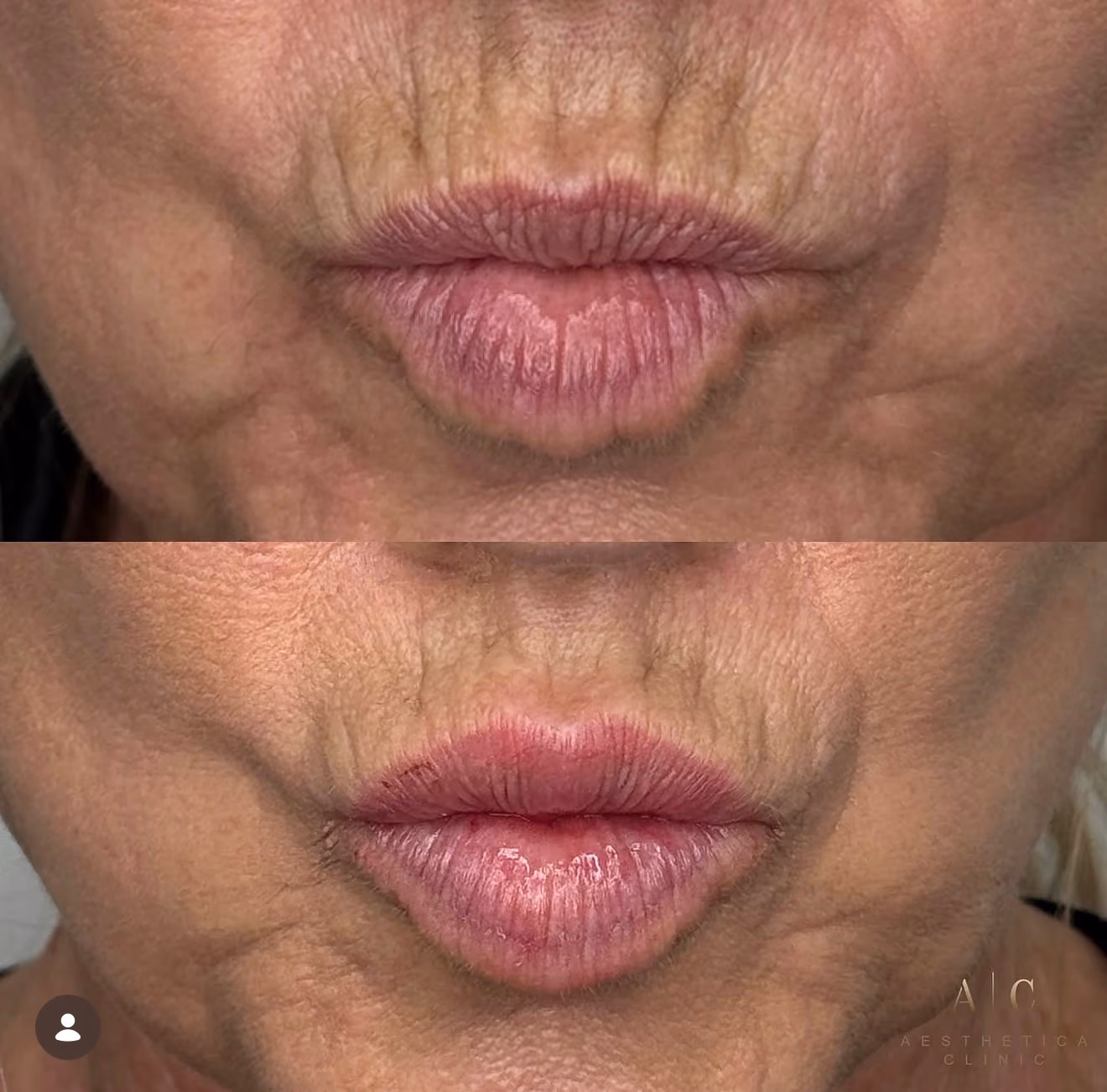 Anti-Wrinkle Treatments Christchurch | Aesthetica Clinic