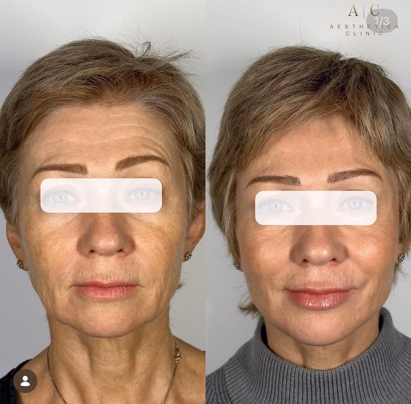 Collagen Stimulation Christchurch | Aesthetica