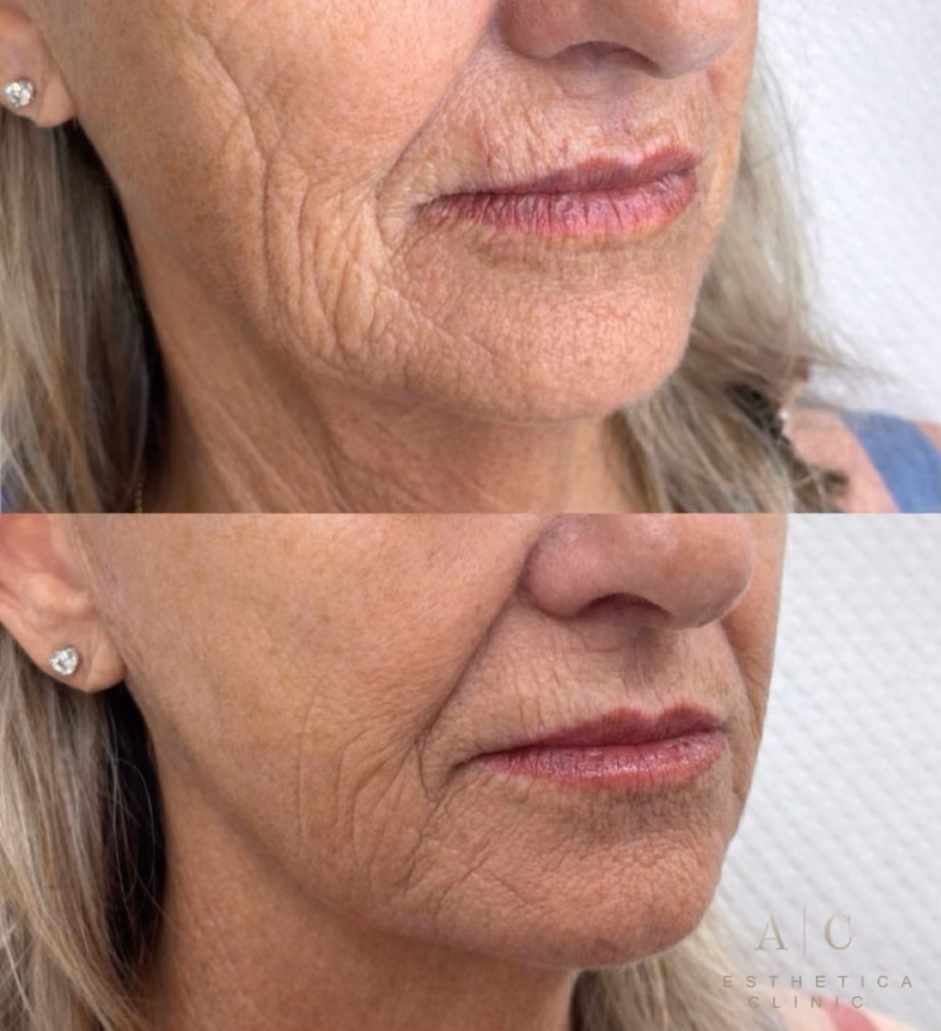 Collagen Stimulation Christchurch | Aesthetica